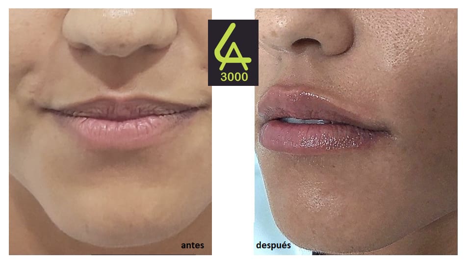 Aumento de Labios hidratación en Toledo