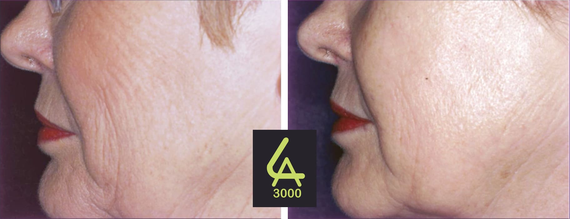 Rejuvenecimiento Facial Láser