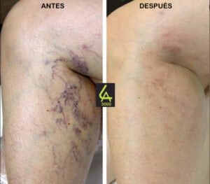 varices piernas